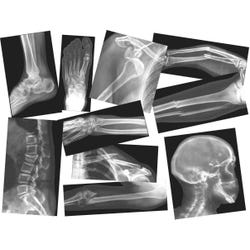 Image for Roylco Broken Bones X-Rays with Teacher Guide - Set of 15 from School Specialty